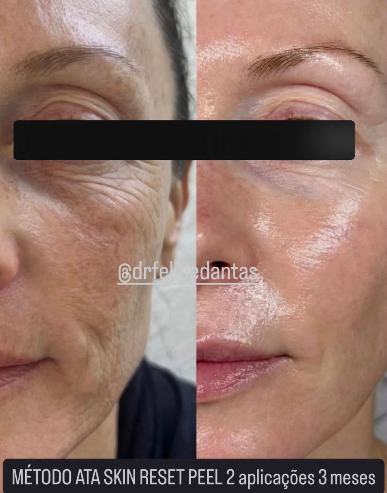 Resultado do método ATA Skin Reset Peel em 2 aplicações