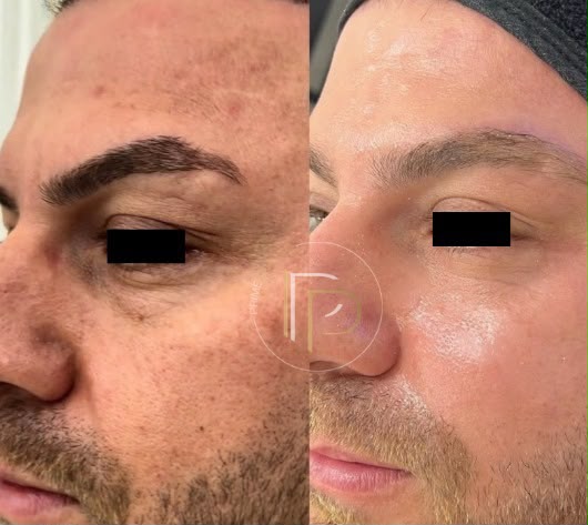 Antes e depois de tratamento com Peeling ATA